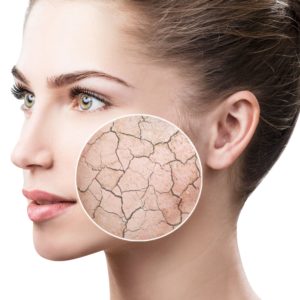 DIsidratazione acuta pelle